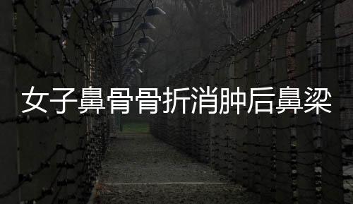 女子鼻骨骨折消腫后鼻梁高挺，重拾自信美