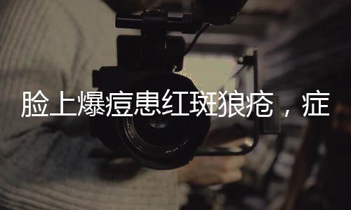 臉上爆痘患紅斑狼瘡，癥狀解析與應(yīng)對之道